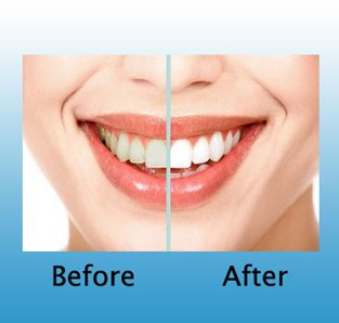 10 Şırıngalı Peroksitsiz Diş Beyazlatıcı Seti Peroksitsiz Jel = Daha Az Hassasiyete Sahip Beyaz Dişler