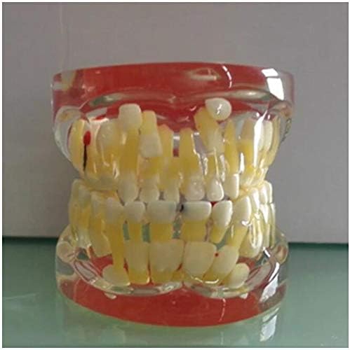 K99 Şeffaf Patolojik Yaprak Döken Dişler Modeli-Diş Modeli-Yaprak Döken Dişlerin Yapısını,Çürüklerini ve Apikal Kistin Patolojik